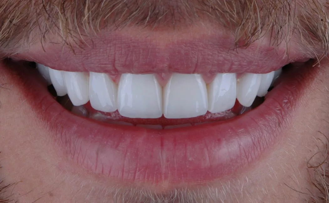 Patient smile transformation