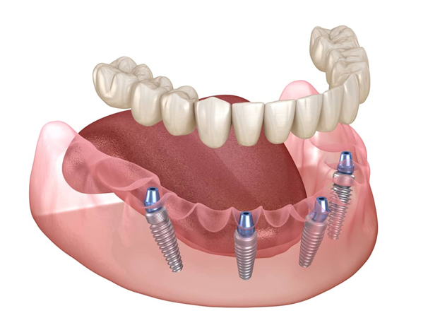 All-on-4 Dental Implants